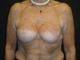 Implant-based breast reconstruction after 867378