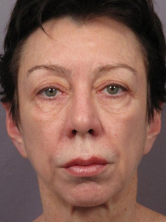 Eyelid Surgery before 280829