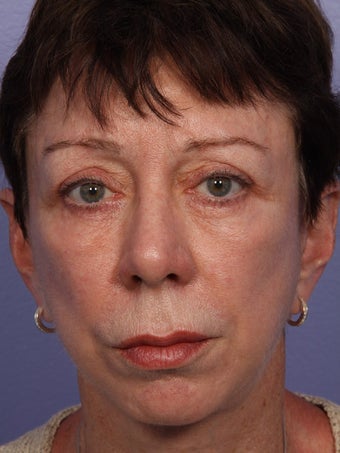 Eyelid Surgery after 280829