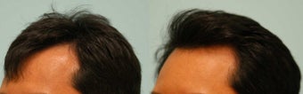 Hair Transplant before 134765