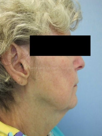 Woman, fillers used to lift cheeks before 851438