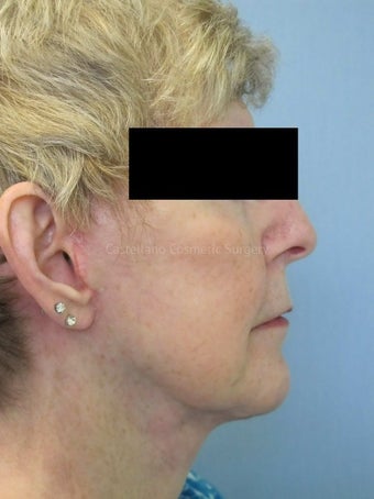 Woman, fillers used to lift cheeks after 851438