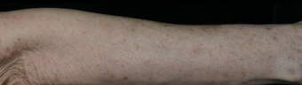 Fraxel after 779542