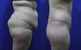 32 Year Old Female Treated for Abdominal Apron & Sagging Buttocks before 1109124