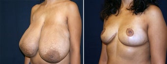 Breast Reduction after 996869