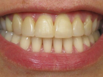 Teeth Whitening & Veneers Before & After Photo before 996253