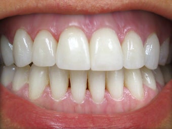 Teeth Whitening & Veneers Before & After Photo after 996253