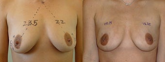 Minimally Invasive Scarless Breast Lift before 1197692