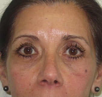 Facial wrinkles, lower lid rhytids (wrinkles) and tear trough hollows after 1032177