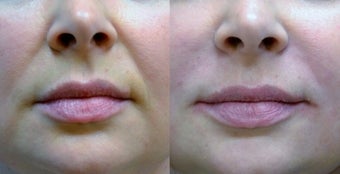 Restylane Filler to Nasolabial Folds before 1306475