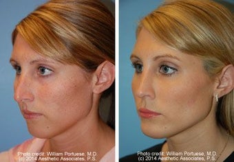 Chin Implant, Rhinoplasty before 91944