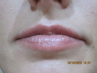 26 Year Old Female Treated for Lip Enhancement before 825200
