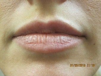 26 Year Old Female Treated for Lip Enhancement after 825200