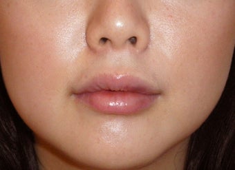 Filler for Lip Augmentation after 124032