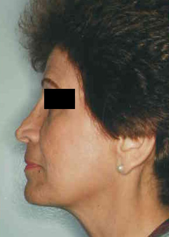 Revision Rhinoplasty before 665082