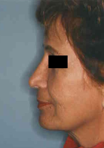 Revision Rhinoplasty after 665082