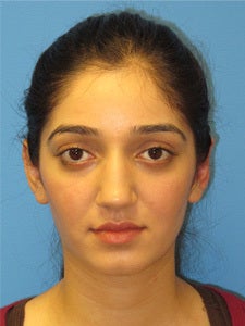 Otoplasty Ear Surgery - Female after 1094355