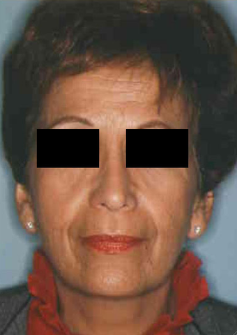 Revision Rhinoplasty after 665083