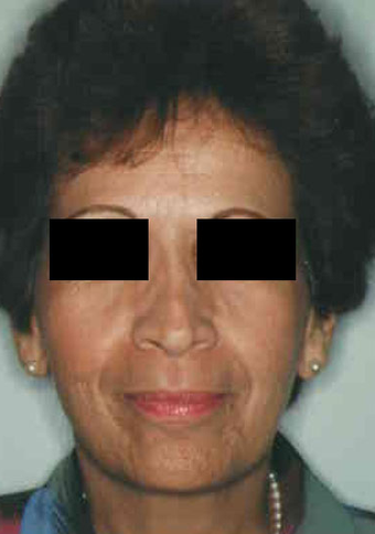 Revision Rhinoplasty before 665083