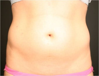 SmartLipo MPX after 686322