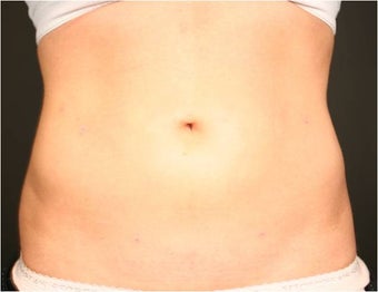 SmartLipo MPX before 686322