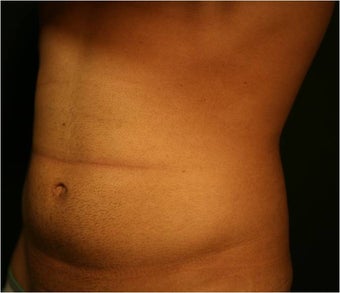 SmartLipo MPX before 686315