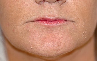 Before and After Lip Lift before 65354