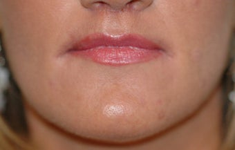 Before and After Lip Lift after 65354