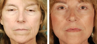 Facelift before 1205205