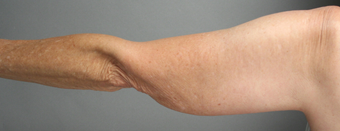 SmartLipo Liposuction of Arms before 275080