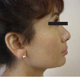Rhinoplasty after 172982