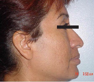 Rhinoplasty before 172982