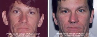 Otoplasty (ear surgery) before 212308