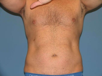 Exilis after 849415