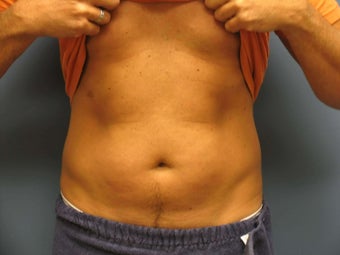 Exilis before 849415