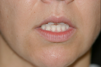 Upper Lip Lift, Fat Transfer and Lower FATMA before 725798