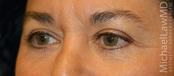 Eye Bags Treatment after 877360