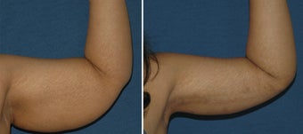 Brachioplasty before 597084