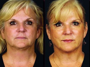 Lazerlift before 1034501