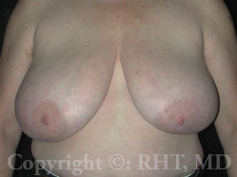 Transgender (F-M) mastectomies ("top surgery") before 309052