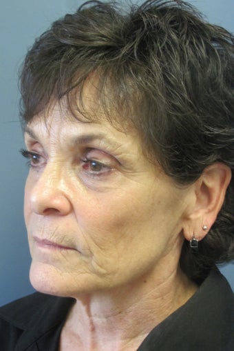 LiteLift™ and Blue Peel on 60-year-old Woman 413743