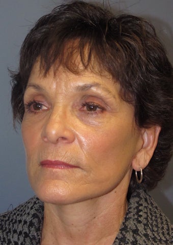 LiteLift™ and Blue Peel on 60-year-old Woman 413743