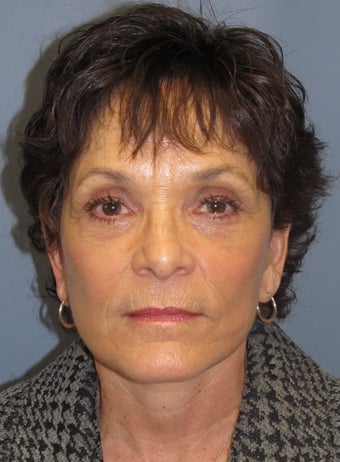 LiteLift™ and Blue Peel on 60-year-old Woman after 413743