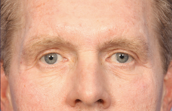 Bilateral eyelid surgery after 321431