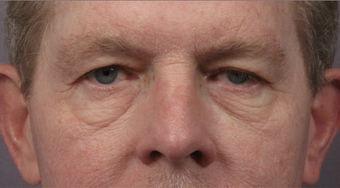 Bilateral eyelid surgery before 321431