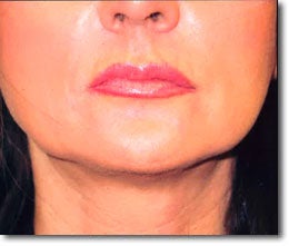 Restylane® and Perlane® after 565996