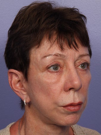 Eyelid Surgery after 280830
