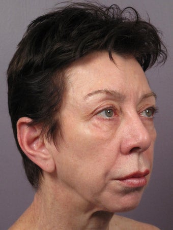 Eyelid Surgery before 280830