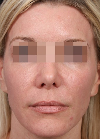 Fraxel 600 for Skin Rejuvenation after 539891