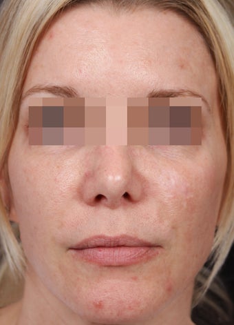 Fraxel 600 for Skin Rejuvenation before 539891